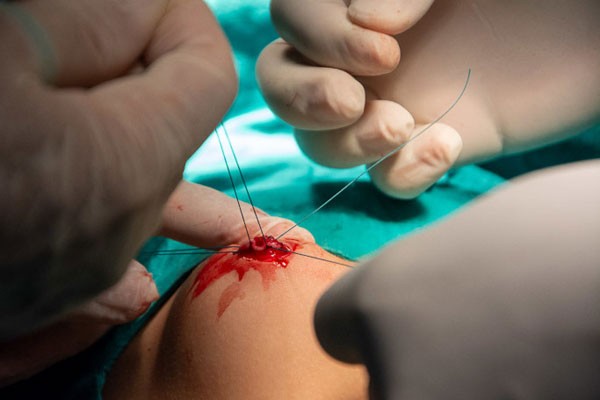 Taller de Reparación Laparoscópica de la Hernia Inguinal Pediátrica