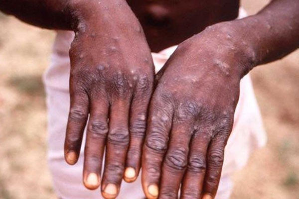 Viruela del simio (Mpox)