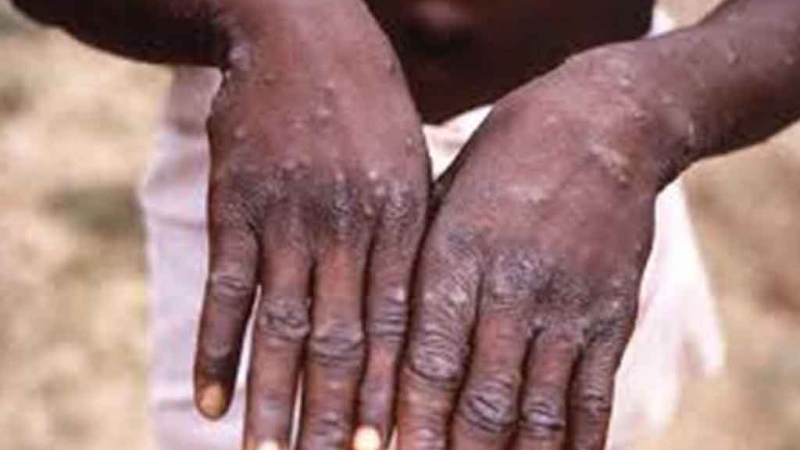 Mpox