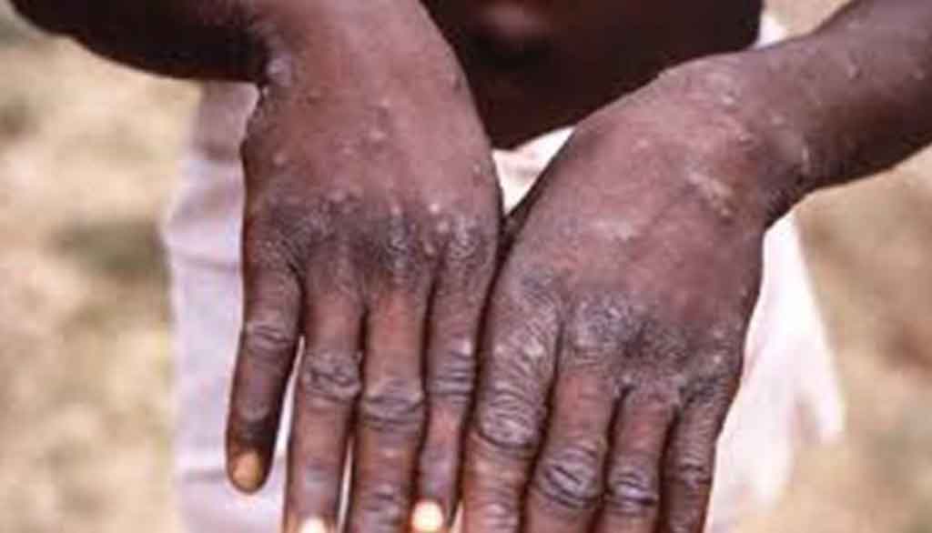 Mpox-casos-1